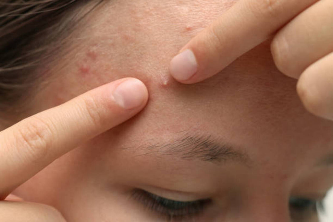 Forehead Acne
