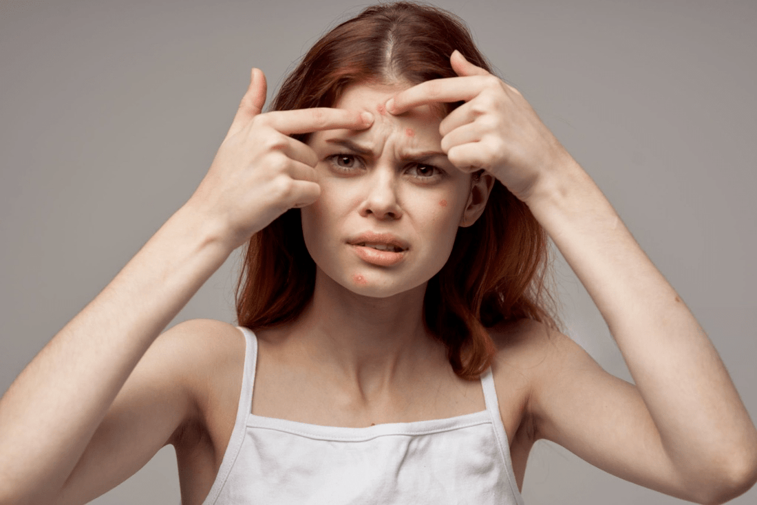 Pimples on forehead