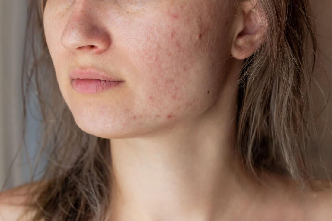 Serum for Acne Scars