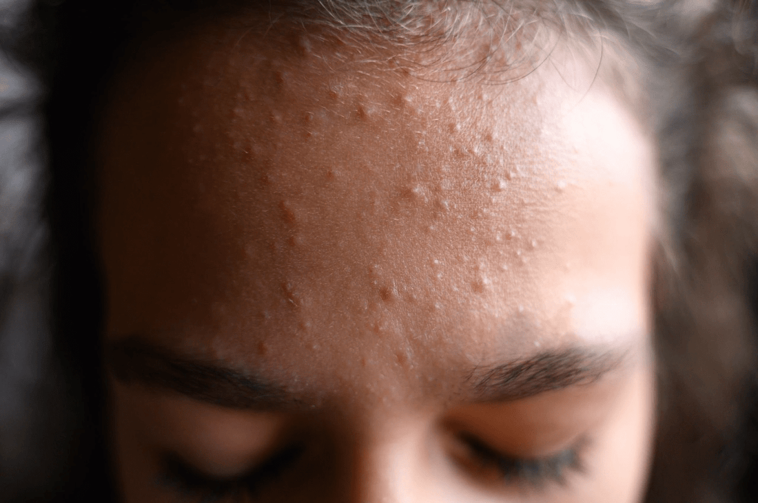 What Causes Forehead Acne