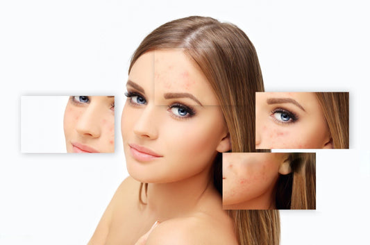 Use Rosehip Oil