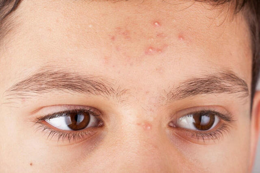 Why Acne on Forehead