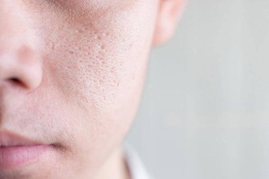 Facial Pores
