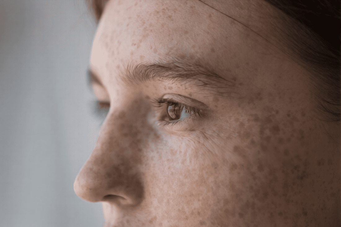 Effective Home Treatment for Sunspots and Freckles