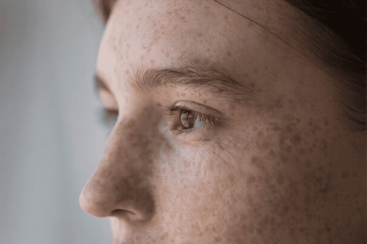Effective Home Treatment for Sunspots and Freckles