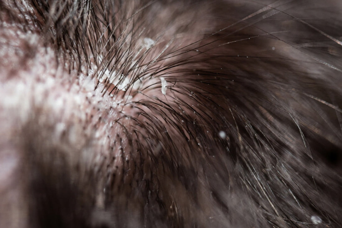 Home Remedies for Dandruff