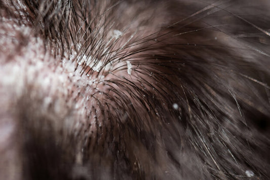 Home Remedies for Dandruff
