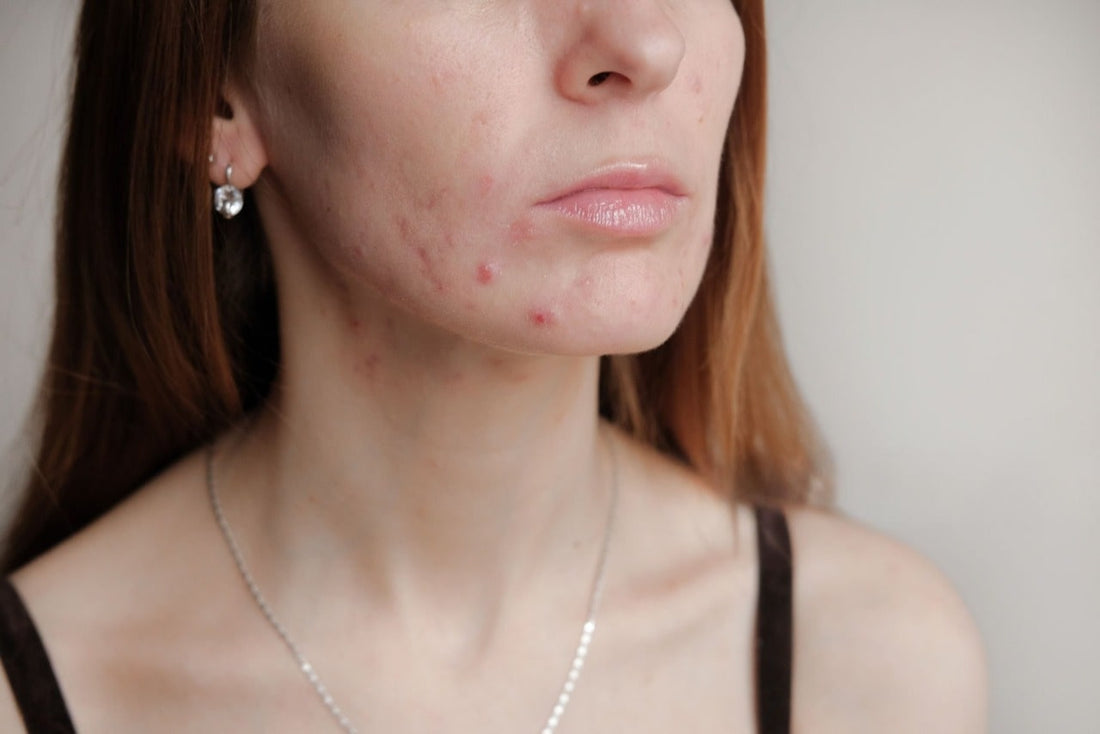 Hormonal Acne Treatment