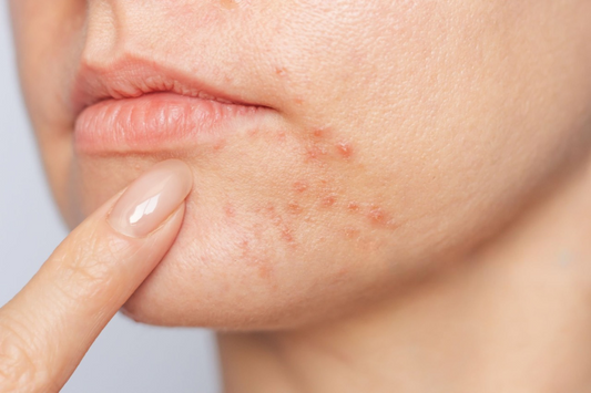 How Long Does Tea Tree Oil Take to Work on Acne