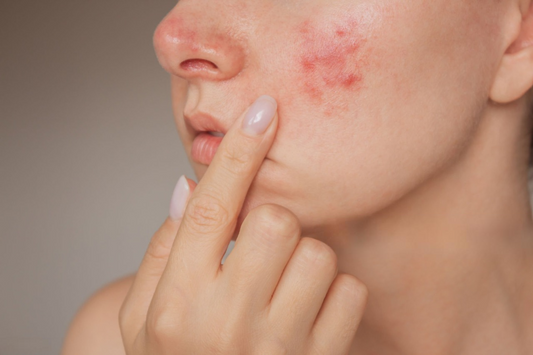 How Tea Tree Oil Works on Acne
