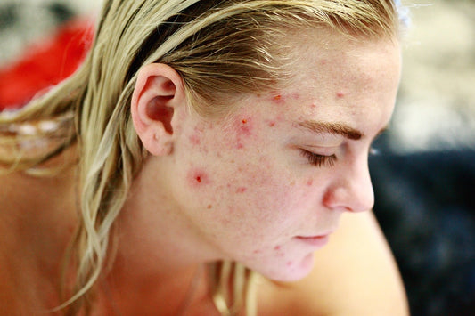How to Get Rid of Acne Scars Permanently