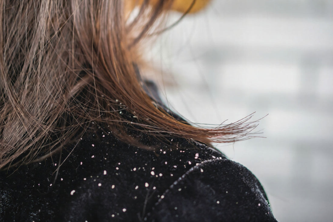 How to Get Rid of Dandruff in Winter