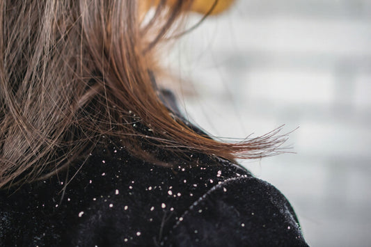 How to Get Rid of Dandruff in Winter