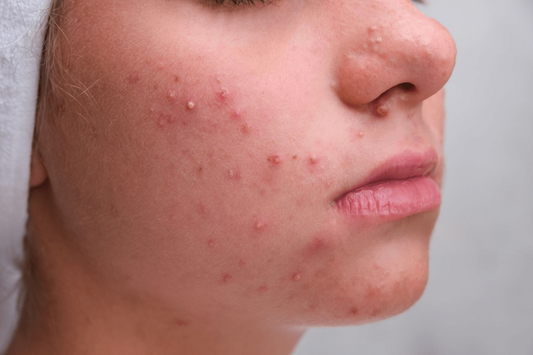How to Stop Pimple Coming on Face