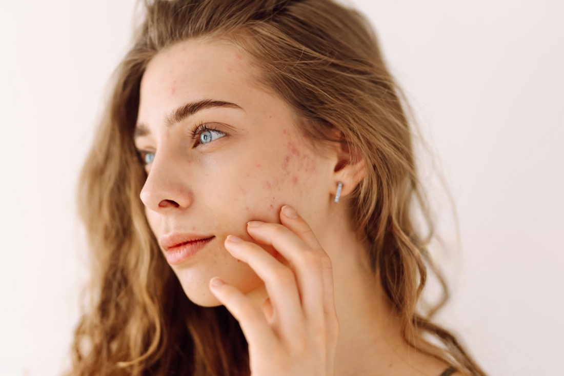 How to Use Tea Tree Oil for Pimples