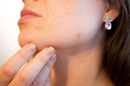 How to Treat Acne Fast