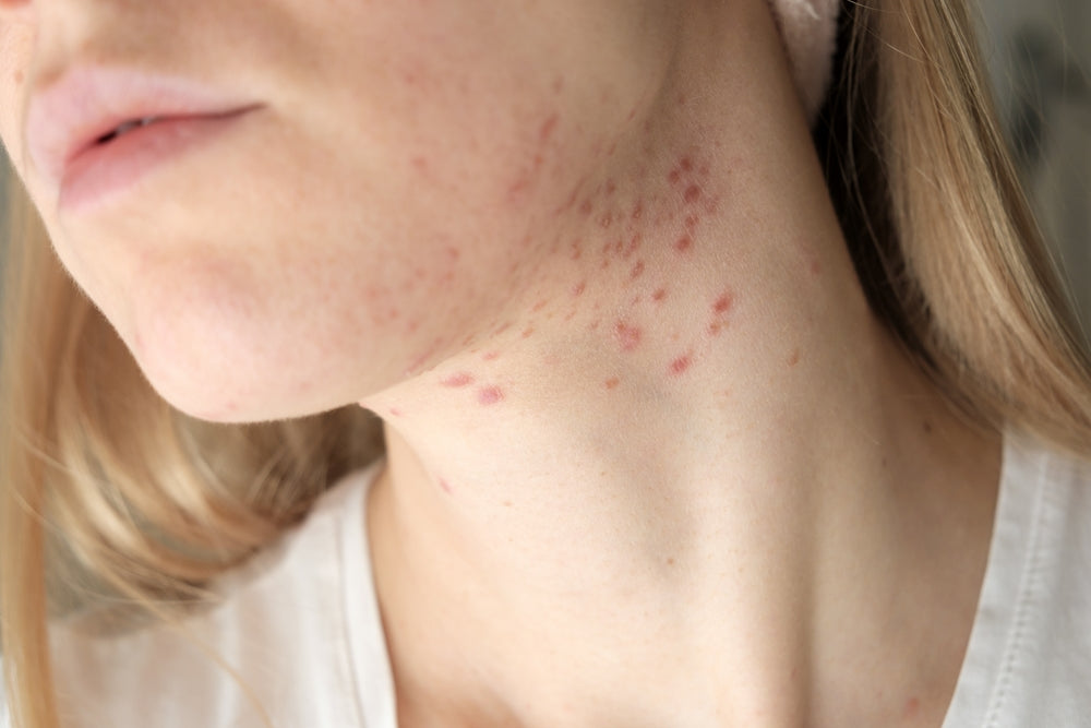 How Is Fungal Acne Different from Bacterial Acne?