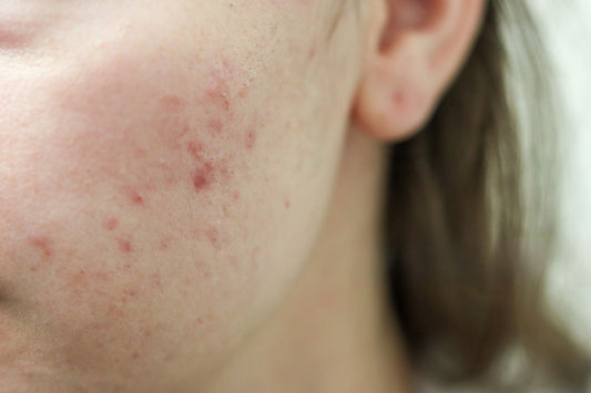 What Causes Acne