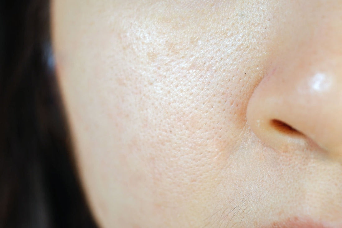 What Is Combination Skin