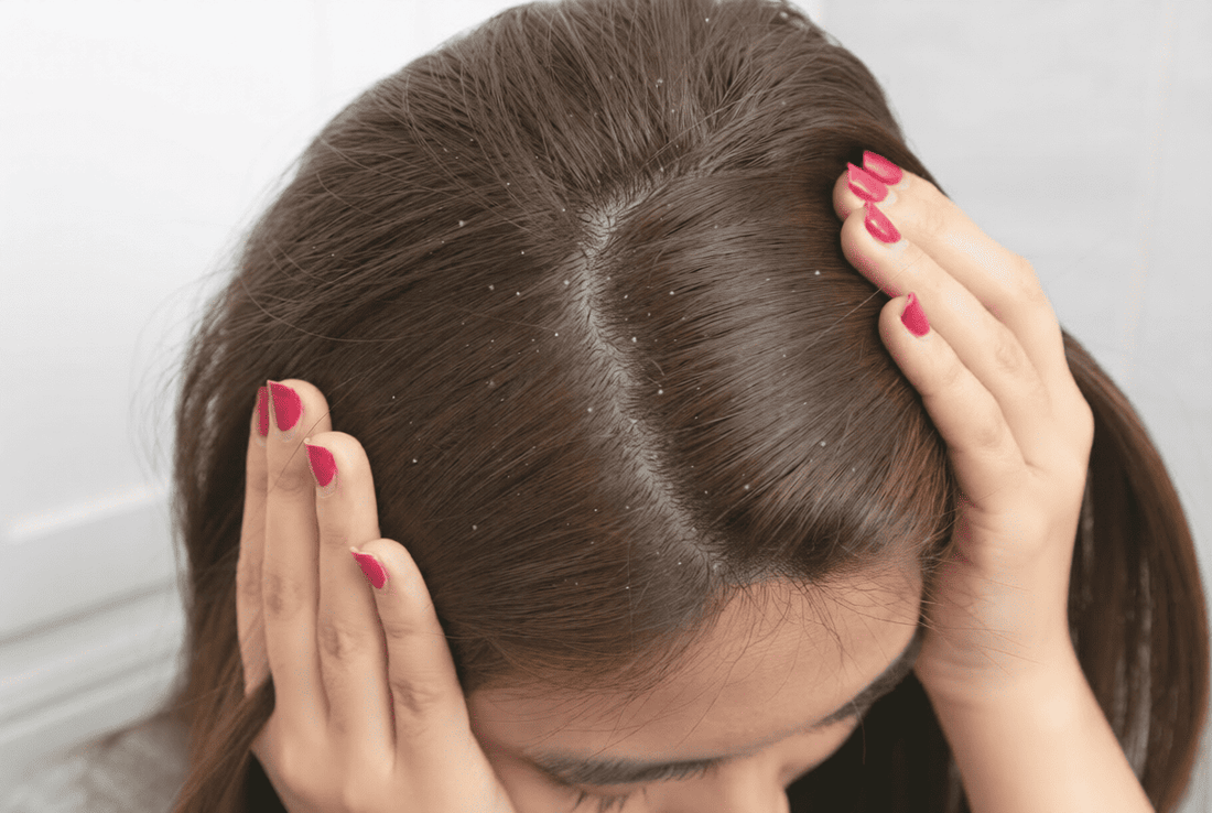 What Is the Best Shampoo for Itchy Scalp and Dandruff