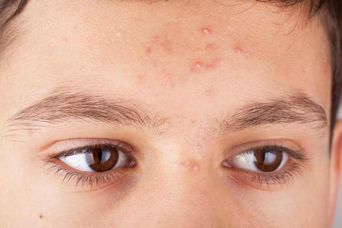 Why Acne on Forehead