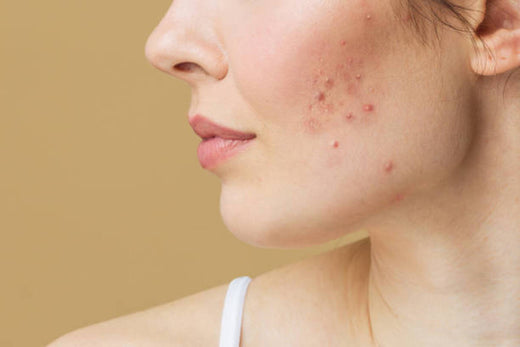 best acne serum