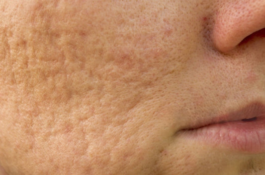 home remedies for open pores