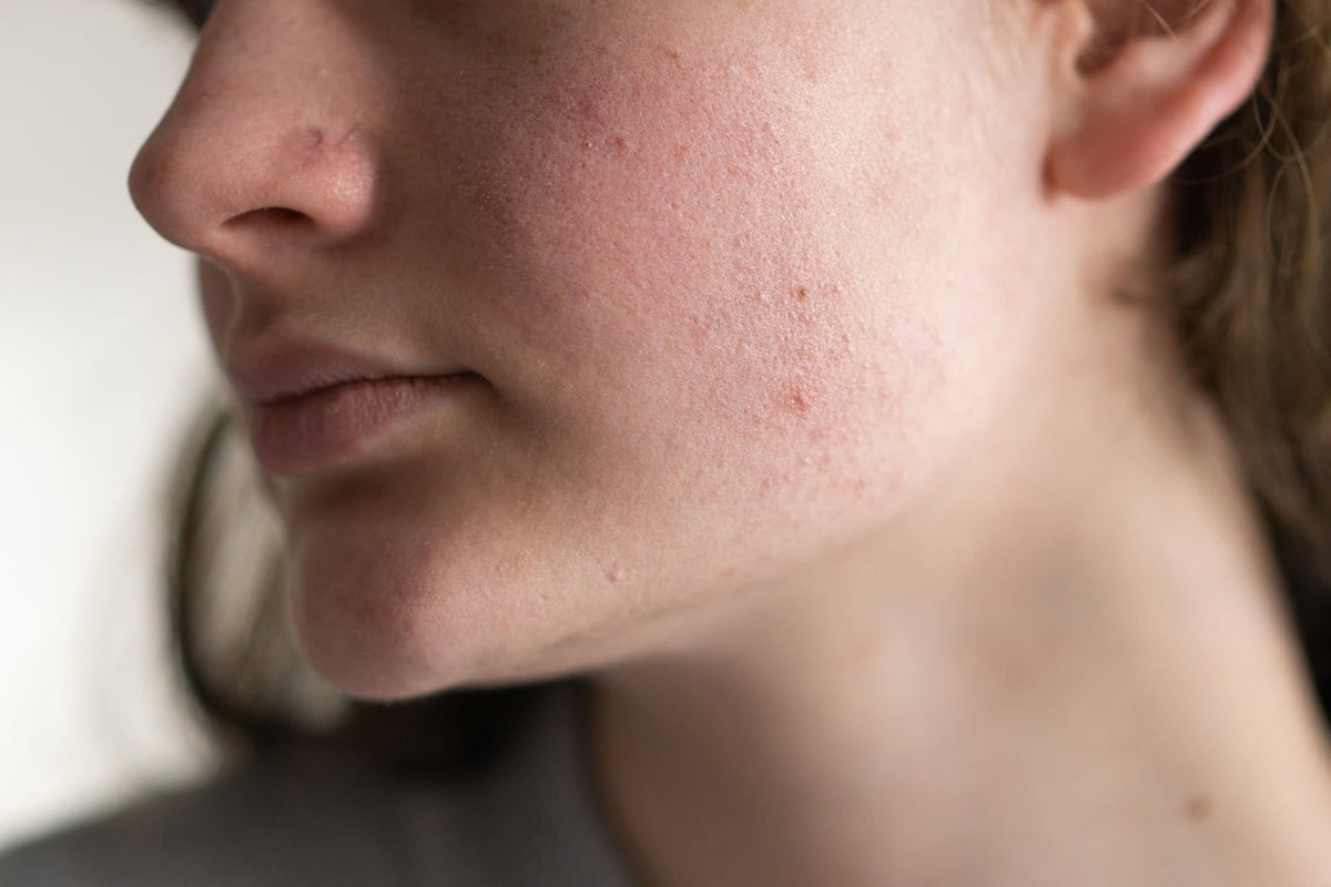 Redness & Irritated Skin